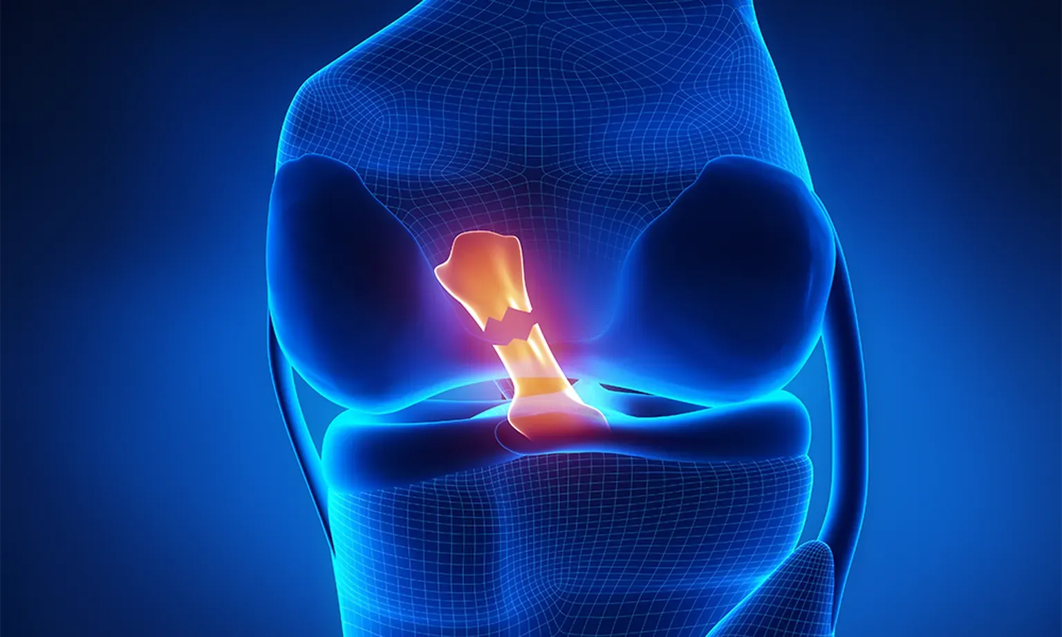 1743427392 2448965 ACL Tear Princeton NJ