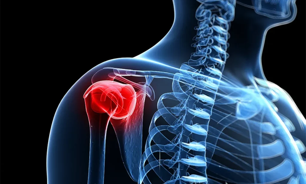 Rotator Cuff Tear Princeton NJ Rotator Cuff Tear Princeton NJ